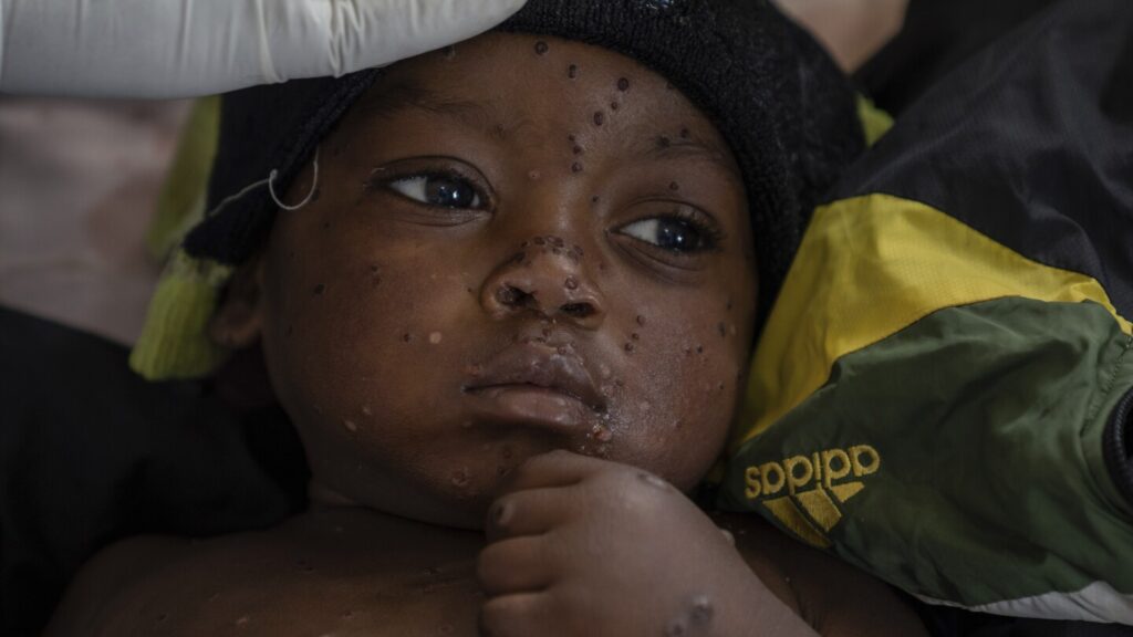 A gold mining town in Congo has become an mpox hot spot as a new strain spreads