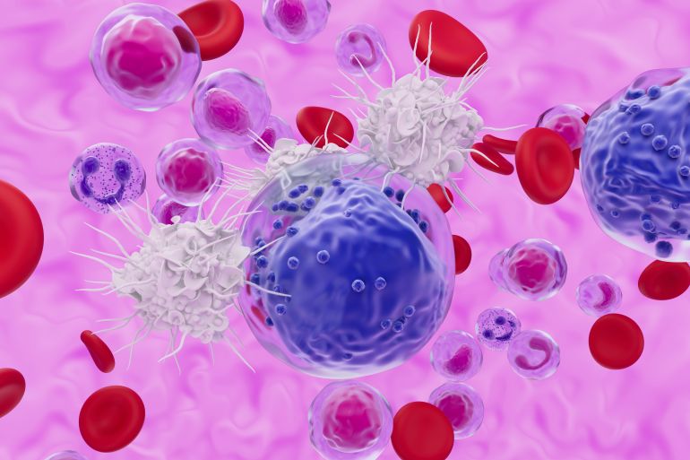 Illustration of T cell white blood cells attacking an acute myeloid leukaemia (AML) cell. This cancer affects the myeloid tissue (bone marrow), specifically the white blood cell precursors (myeloblasts) that form a type of white blood cell known as granulocytes. These immature cells fill up the bone marrow and spill into the bloodstream and circulate throughout the body. The cells do not work properly to fight infections and their increased production reduces the production of red blood cells leading to anaemia and fatigue. Acute leukaemias progress quickly. T lymphocytes, or T cells, are a type of white blood cell and a component of the body's immune system. They recognise a specific site (antigen) on the surface of a pathogen or cancerous cell, bind to it, and attract antibodies or cells to eliminate it